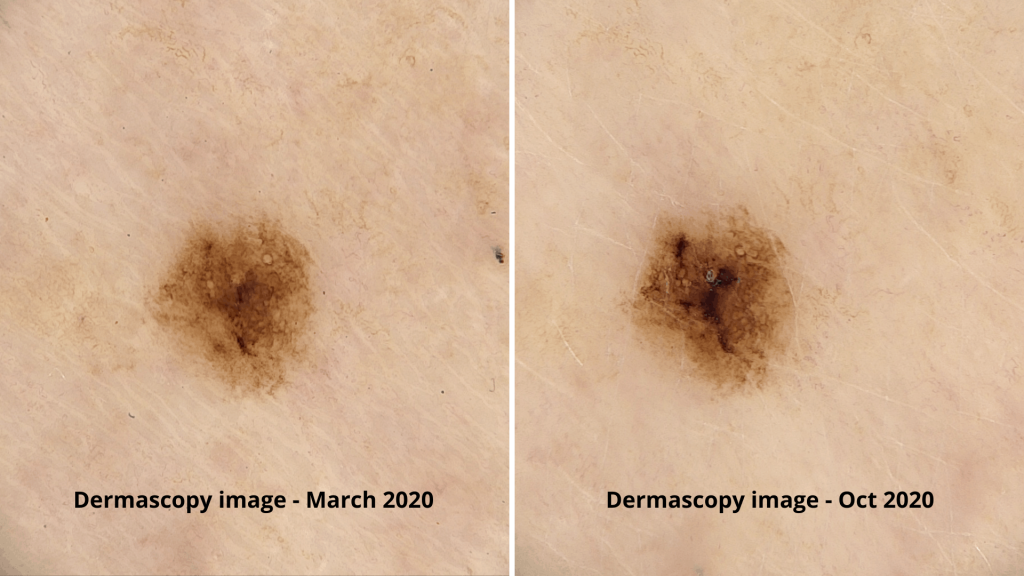 Dermascopy over time compared