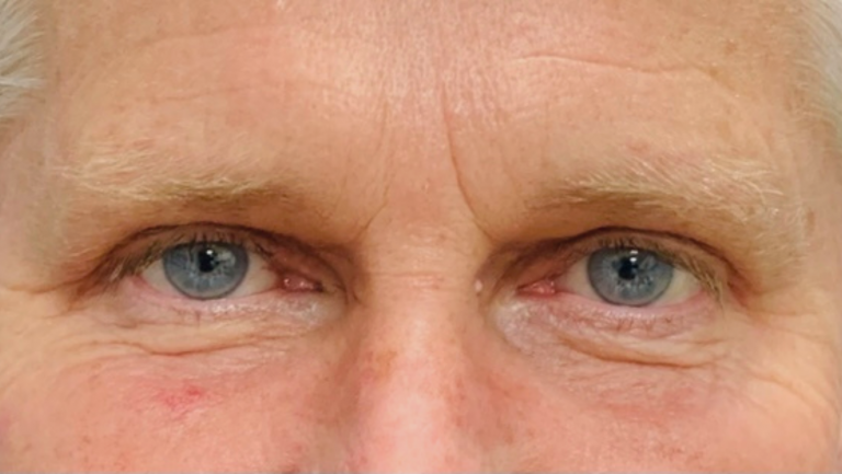 After Upper Eyelid Surgery - Male