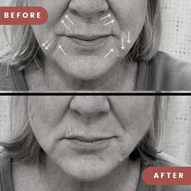 Before and After Thread Lift for Marionette Lines and Nasolabial Folds showing smoother facial lines on female face