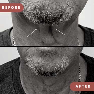 Before and After Thread Lift to smooth saggy skin on the throat of man
